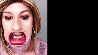 Braces fetish! See Alexandra Braces with an open mouth expander